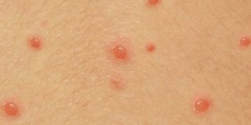 Ръст на заболелите от варицела във Варна