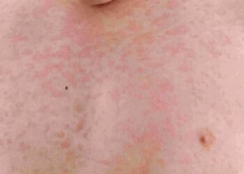 38 случая на скарлатина са регистрирани през изминалата седмица във Варна и областта