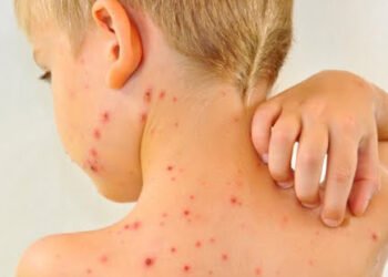 Отново ръст на заболелите от варицела във Варна