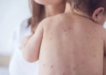 Дете с варицела – здравните власти отчитат нови случаи на инфекцията във Варна